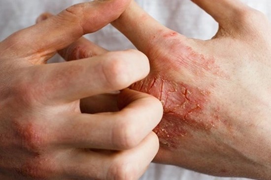 2 bộ phận trên cơ thể bị ngứa là dấu hiệu mắc bệnh tiểu đường