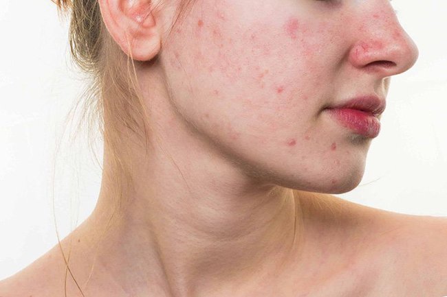 Chuyên gia cảnh báo 4 bước chăm sóc da dễ khiến da kích ứng-1