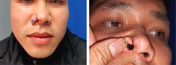 Người đàn ông phát hiện ung thư chỉ từ sẩn đỏ ở cánh mũi-1