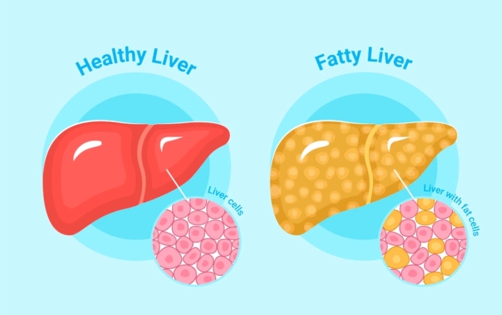 Những hành vi làm hỏng gan nhanh nhất, bạn nên biết để tránh-1