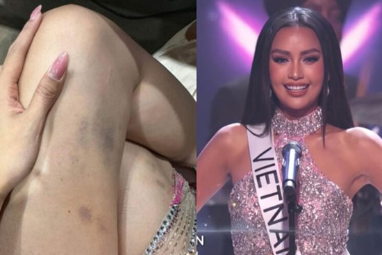 Xót xa cho Ngọc Châu: Viết tâm thư xin lỗi khán giả vì trượt Top 16, lộ đôi chân bầm tím và hình ảnh khóc nức nở sau hậu trường