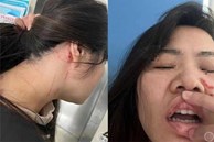 Phẫn nộ cô gái bị đánh nhập viện vì từ chối đi xem mắt