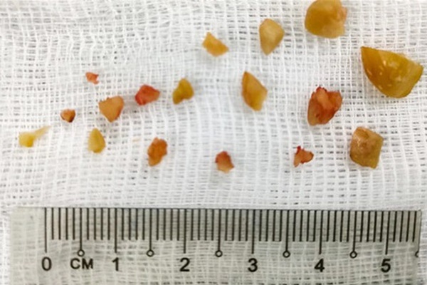 Có dấu hiệu bất thường này cần thận trọng cơn suy hô hấp sắp xảy ra, chủ quan có thể mất mạng-4