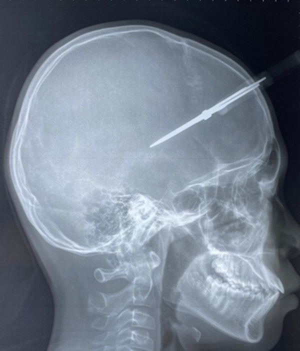 Bé trai 12 tuổi bị kéo thủ công đâm thủng hộp sọ-2