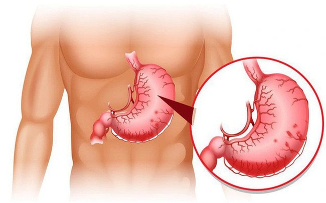 Làm thế nào để tránh cơn đau dạ dày bùng phát vào dịp Tết?-1