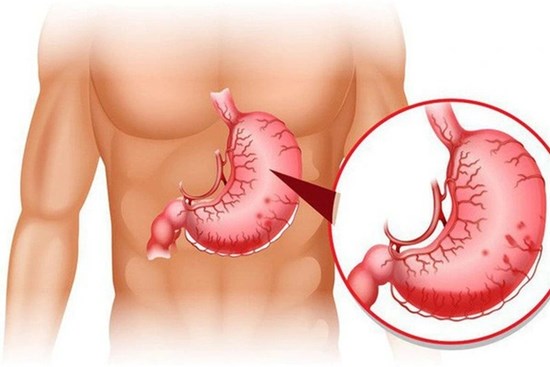 Làm thế nào để tránh cơn đau dạ dày bùng phát vào dịp Tết?