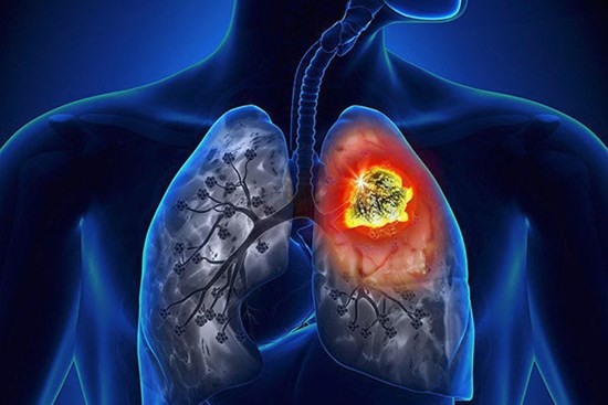 Có 2 dấu hiệu này đi khám, người đàn ông phát hiện ung thư di căn