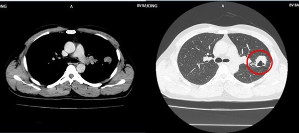 Có 2 dấu hiệu này đi khám, người đàn ông phát hiện ung thư di căn-1