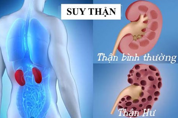 Dấu hiệu nhận biết bệnh suy thận bạn cần biết-1