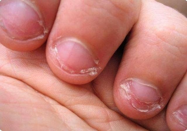 Điều gì sẽ xảy ra với một đứa trẻ hay cắn móng tay khi lớn lên? Bác sĩ chỉ ra 4 tình huống hay xuất hiện-4
