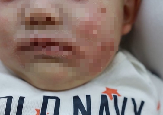 Hàng ngàn người đến bệnh viện điều trị da sau kỳ nghỉ Tết-3