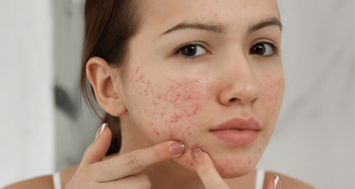 Tại sao nên massage da bằng đá lạnh?-3