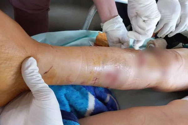 Sang nhà hàng xóm chơi, bé 3 tuổi bị chó cắn rách mặt-2