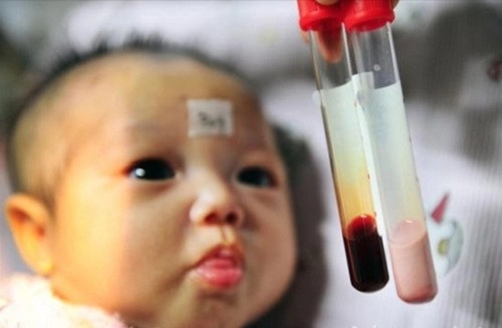Thalassemia - căn bệnh khiến trẻ thiếu máu nhưng thừa sắt bẩm sinh-1