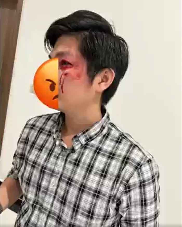 Bảo vệ bé trai khỏi chó dữ, thanh niên bị đấm nát mặt-2