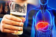 Dấu hiệu cơ thể cảnh báo gan của bạn đang 'kêu cứu', 4 nhóm người này cần cảnh giác