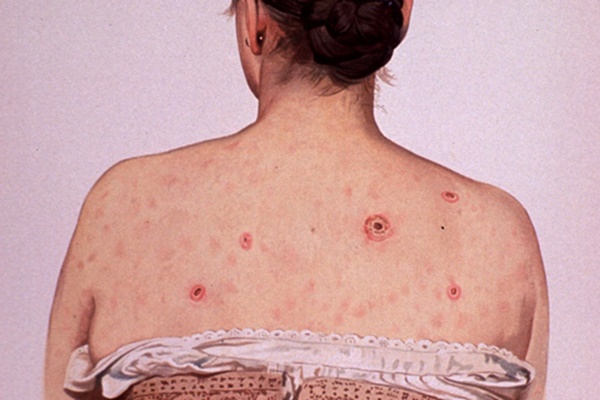 Dấu hiệu bệnh giang mai bẩm sinh ở trẻ-3