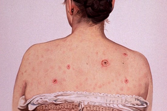 Bệnh giang mai diễn biến phức tạp trên toàn cầu