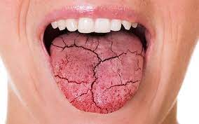 Tạm biệt chứng khô miệng chỉ với những mẹo đơn giản-1