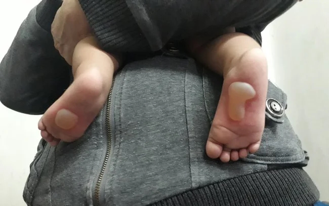 Xót xa bé 8 tháng bị bỏng da phồng rộp đau đớn do đắp tỏi chữa bệnh-1