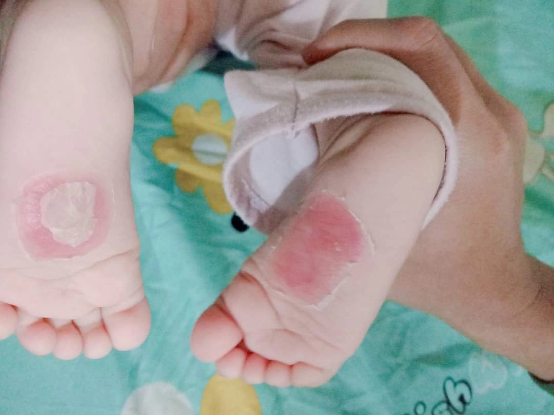 Xót xa bé 8 tháng bị bỏng da phồng rộp đau đớn do đắp tỏi chữa bệnh-2