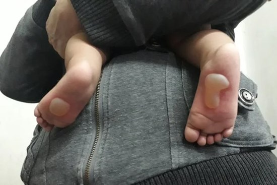 Xót xa bé 8 tháng bị bỏng da phồng rộp đau đớn do đắp tỏi chữa bệnh