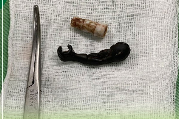 Nhiều dị vật trong vùng kín bé gái 5 tuổi-1