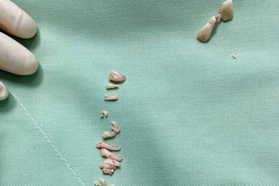 Phát hiện 30 chiếc răng nằm trong khối u