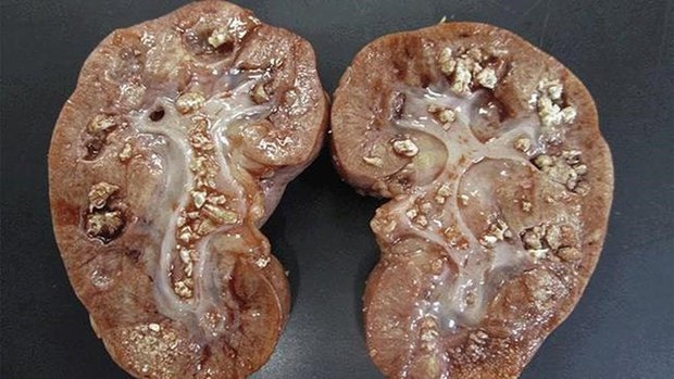 4 thói quen ăn uống khiến sỏi thận xuất hiện ngày càng nhiều-1