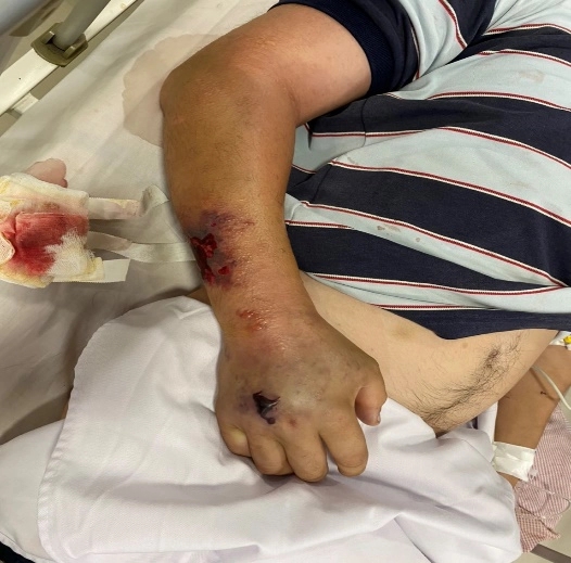 Thanh niên 26 tuổi bị gout mãn tính gây sốc nhiễm khuẩn nặng, may mắn được cứu sống-1