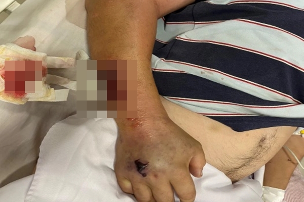 Người phụ nữ nguy kịch nghi nhiễm bệnh từ nghề giết mổ lợn-2