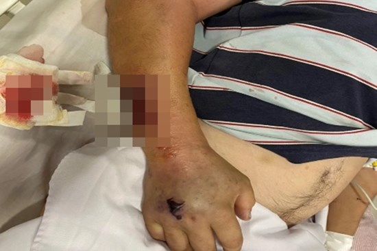 Thanh niên 26 tuổi bị gout mãn tính gây sốc nhiễm khuẩn nặng, may mắn được cứu sống