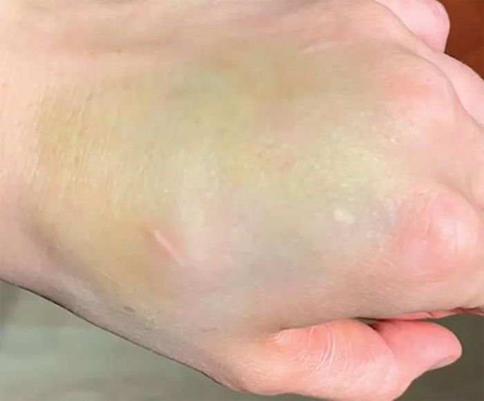 Vết bầm tưởng vô hại trên tay là dấu hiệu ung thư-1