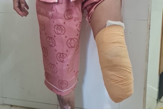 Người đàn ông bị cắt bàn chân vì chủ quan với vết bầm tím nhỏ