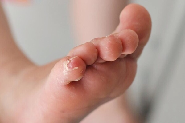 Đi khám vì tóc rụng, người đàn ông bất ngờ phát hiện mắc giang mai-2