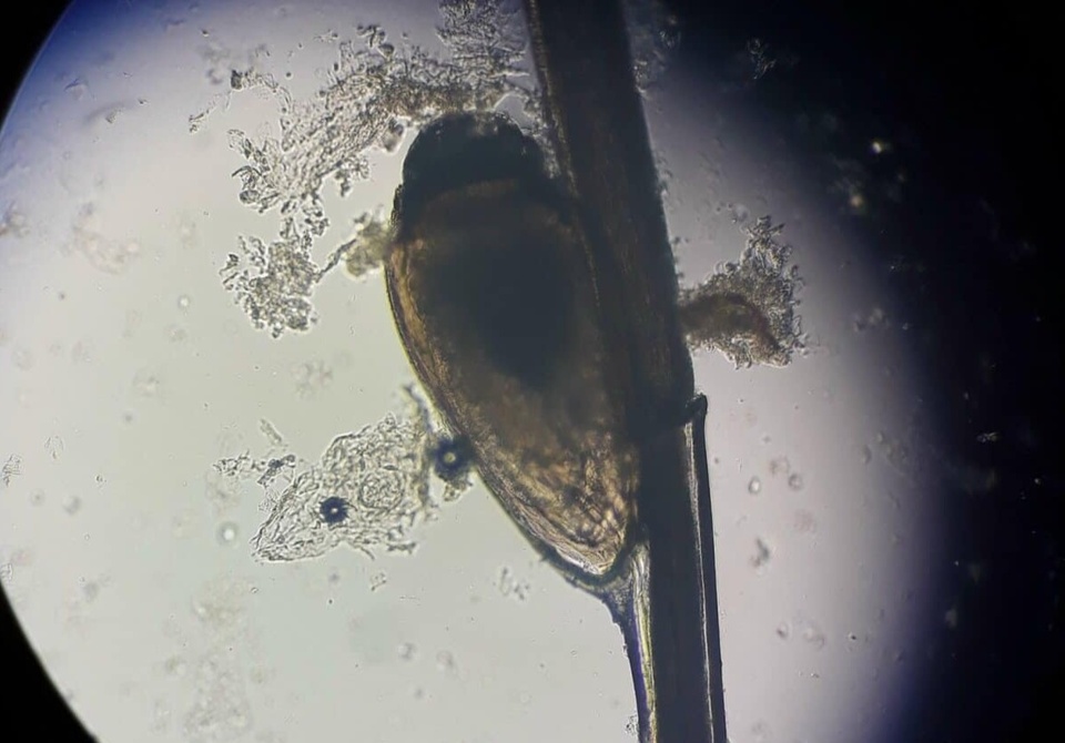 Ký sinh trùng làm tổ ở nách người đàn ông suốt 2 tháng-1