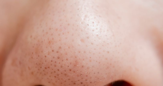 Chuyên gia da liễu chỉ rõ sản phẩm cần dùng để cải thiện 3 kiểu lỗ chân lông to phát sinh khi da lão hóa-6