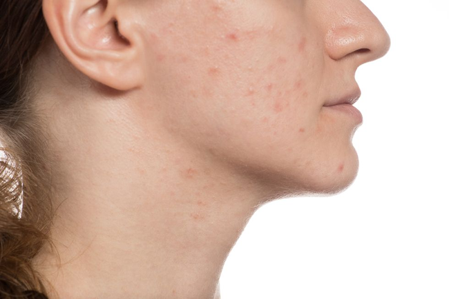 Chuyên gia da liễu chỉ rõ sản phẩm cần dùng để cải thiện 3 kiểu lỗ chân lông to phát sinh khi da lão hóa-7