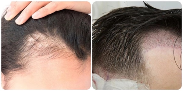 Cấy tóc có an toàn không?-1