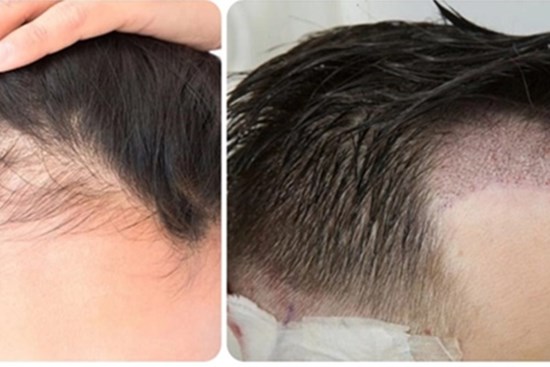 Cấy tóc có an toàn không?