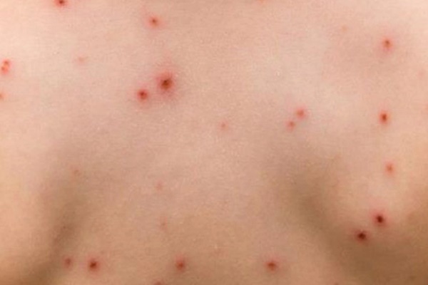 Đắk Lắk: Ghi nhận 2 ổ dịch thủy đậu tại huyện Lắk và TP. Buôn Ma Thuột-1