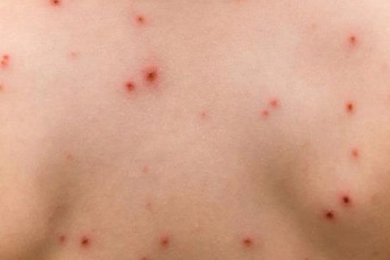 Đắk Lắk: Ghi nhận 2 ổ dịch thủy đậu tại huyện Lắk và TP. Buôn Ma Thuột