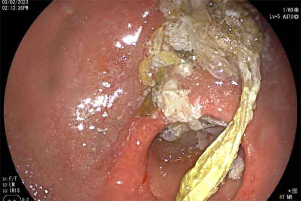 Người tiểu đường có thể ăn cam được hay không?-4