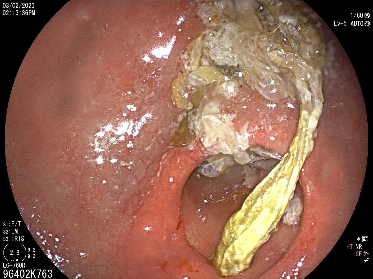 Cơ thể suy kiệt vì bã thức ăn dài 20cm trong dạ dày-1