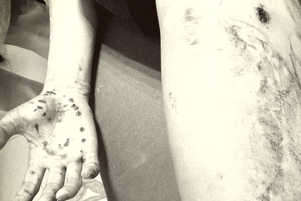 Điện thoại phát nổ khi đang sạc pin, một phụ nữ bị dập nát bàn tay-2