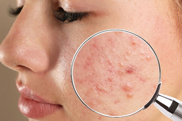 Cách dùng mật ong trị mụn-3