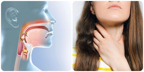Dấu hiệu ung thư vòm họng giai đoạn đầu-1