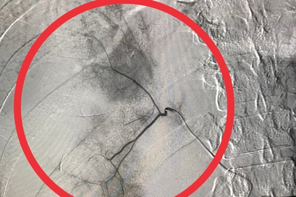 Dùng dây đai nịt bụng để giảm cân, nữ bệnh nhân vỡ gan-2