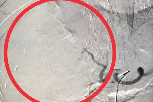 Dùng dây đai nịt bụng để giảm cân, nữ bệnh nhân vỡ gan-3