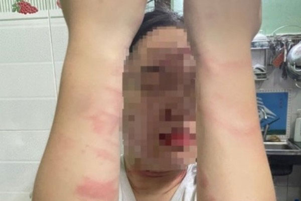 Điều tra vụ việc thiếu nữ 17 tuổi bị mẹ ruột đánh gây thương tích ở TP Thủ Đức-1